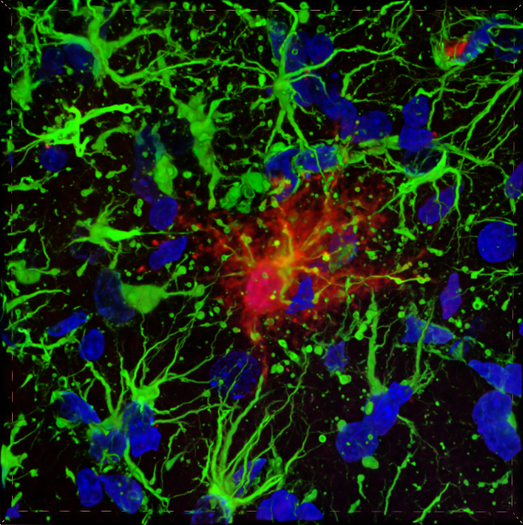 Microscopic image of brain cells showing signs of glial fibrillary acidic protein.